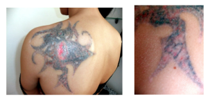 Farbumschlag und Pigmentstörungen und sogar Schmerzen nach Laserbehandlung; rechts Detailansicht (5) 